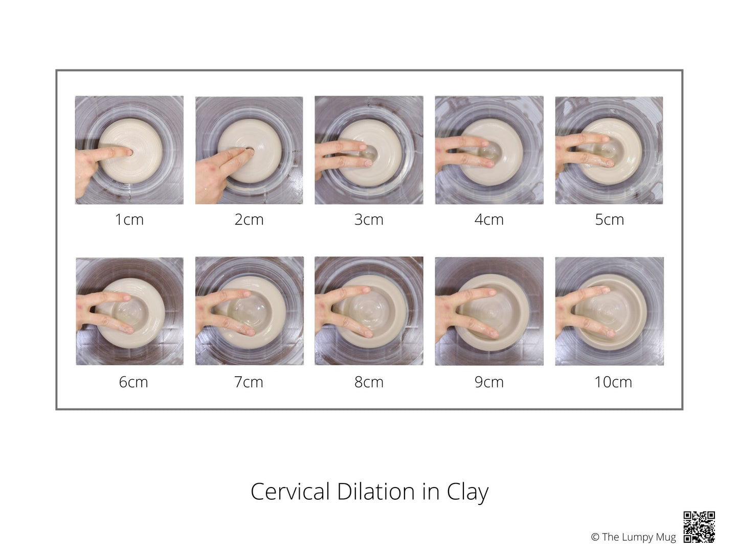 Cervical Dilation Poster